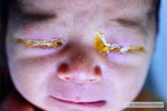 conjuntivitis-gonococcica-bil-1987-000
