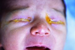 conjuntivitis-gonococcica-bil-1987-001
