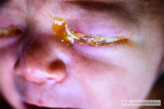 conjuntivitis-gonococcica-bil-1987-003