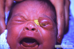conjuntivitis-gonococcica-blefaritis-002