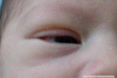 conjuntivitis-gonococcica-ojo-izq-2005-001