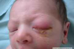 conjuntivitis-gonococcica-ojo-izq-2005-004