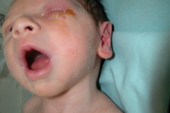 conjuntivitis-gonococcica-ojo-izq-2005-005