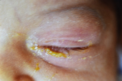 conjuntivitis-purulenta-ojo-izq-001