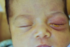 conjuntivitis-purulenta-ojo-izq-002