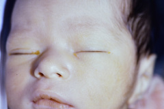 conjuntivitis-simple-000