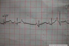 contraccion-auricular-prematura-ectopica-cape-2004-000