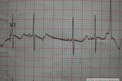 contraccion-auricular-prematura-ectopica-cape-2004-001