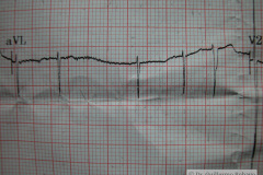 contraccion-auricular-prematura-ectopica-cape-2004-002