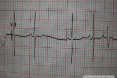 contraccion-auricular-prematura-ectopica-cape-2004-004