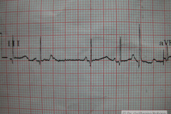 contraccion-auricular-prematura-ectopica-cape-2004-005