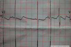 contraccion-auricular-prematura-ectopica-cape-2004-006
