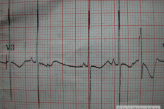 contraccion-auricular-prematura-ectopica-cape-2004-009