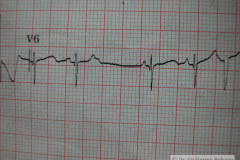 contraccion-auricular-prematura-ectopica-cape-2004-010