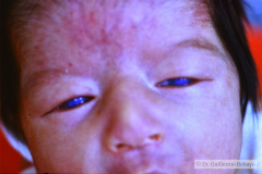 cornea-opaca-bil-000
