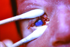 cornea-opaca-bil-001
