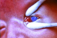 cornea-opaca-bil-002