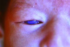 cornea-opaca-bil-003