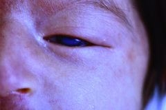 cornea-opaca-bil-004