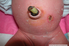 costra-escoriacion-periumbilical-esparadrapo-000