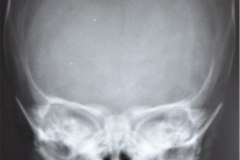 craneo-y-ecografia-cerebral-normal-pretermino-1989-004