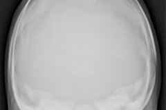 craneosinostosis-sagital-5d-2009-001