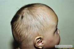 craneosinostosis-sagital-o-longitudinal-escafocfalia-6m-wn-3d-1997-001