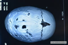 craneosinostosis-sagital-o-longitudinal-escafocfalia-6m-wn-3d-1997-007