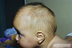 craneosinostosis-sagital-o-longitudinal-escafocfalia-6m-wn-3d-1997-010