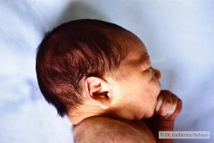 criptorquidia-bil-e-implantacion-baja-pabellon-auricular-001