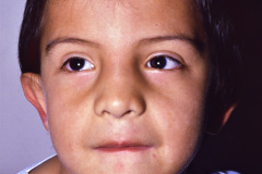 criptorquidia-bil-simbraquicefalia-pie-izq-agenesia-antepie-fusion-dental-1993-001