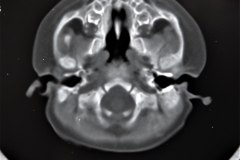 crouzon-pelvis-normal-rn5m-tac-1999-003