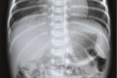 crouzon-pelvis-normal-rn5m-tac-1999-004