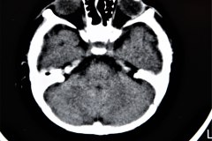 crouzon-pelvis-normal-rn5m-tac-1999-009