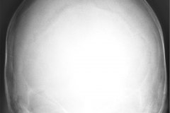 crouzon-pelvis-normal-rn5m-tac-1999-010