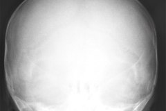 crouzon-pelvis-normal-rn5m-tac-1999-015
