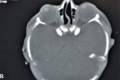 crouzon-pelvis-normal-rn5m-tac-1999-016