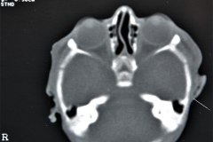 crouzon-pelvis-normal-rn5m-tac-1999-021