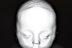 crouzon-reconstruccion-tridimencional-3d-1999-000