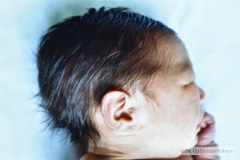 cutis-laxa-rn-8-d-007