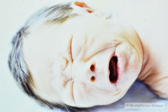 cutis-laxa-rn-8-d-008