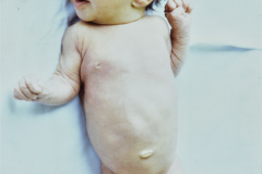 cutis-laxa-rn-8-d-014