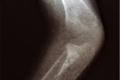 de-toni-debre-faconi-osteopenia-raquitismo-001