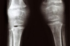 de-toni-debre-faconi-osteopenia-raquitismo-005