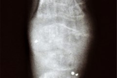 de-toni-debre-faconi-osteopenia-raquitismo-008