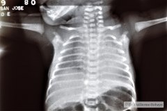 de-toni-debre-faconi-osteopenia-raquitismo-010