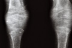 de-toni-debre-faconi-osteopenia-raquitismo-012