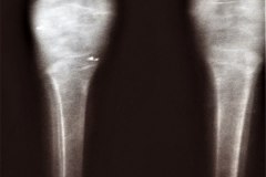 de-toni-debre-faconi-osteopenia-raquitismo-013