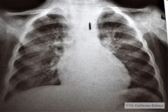 de-toni-debre-faconi-osteopenia-raquitismo-014