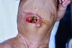 dehiscencia-de-suturas-000